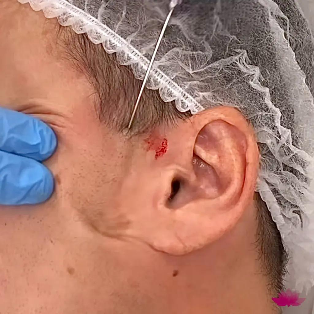 Aplikacja nici liftingujących na twarz