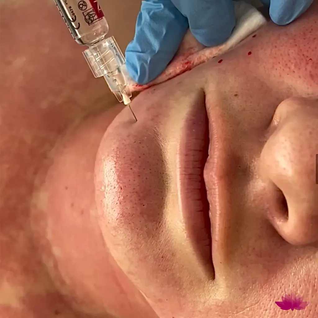 Mezoterapia igłowa na twarz