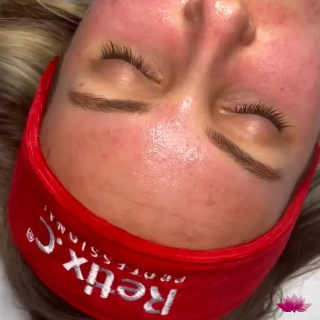 Wygląd skóry po terapii retinolowej