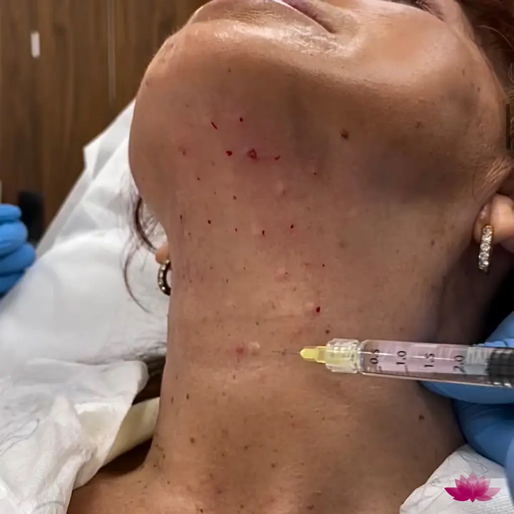 Mezoterapia igłowa na szyję