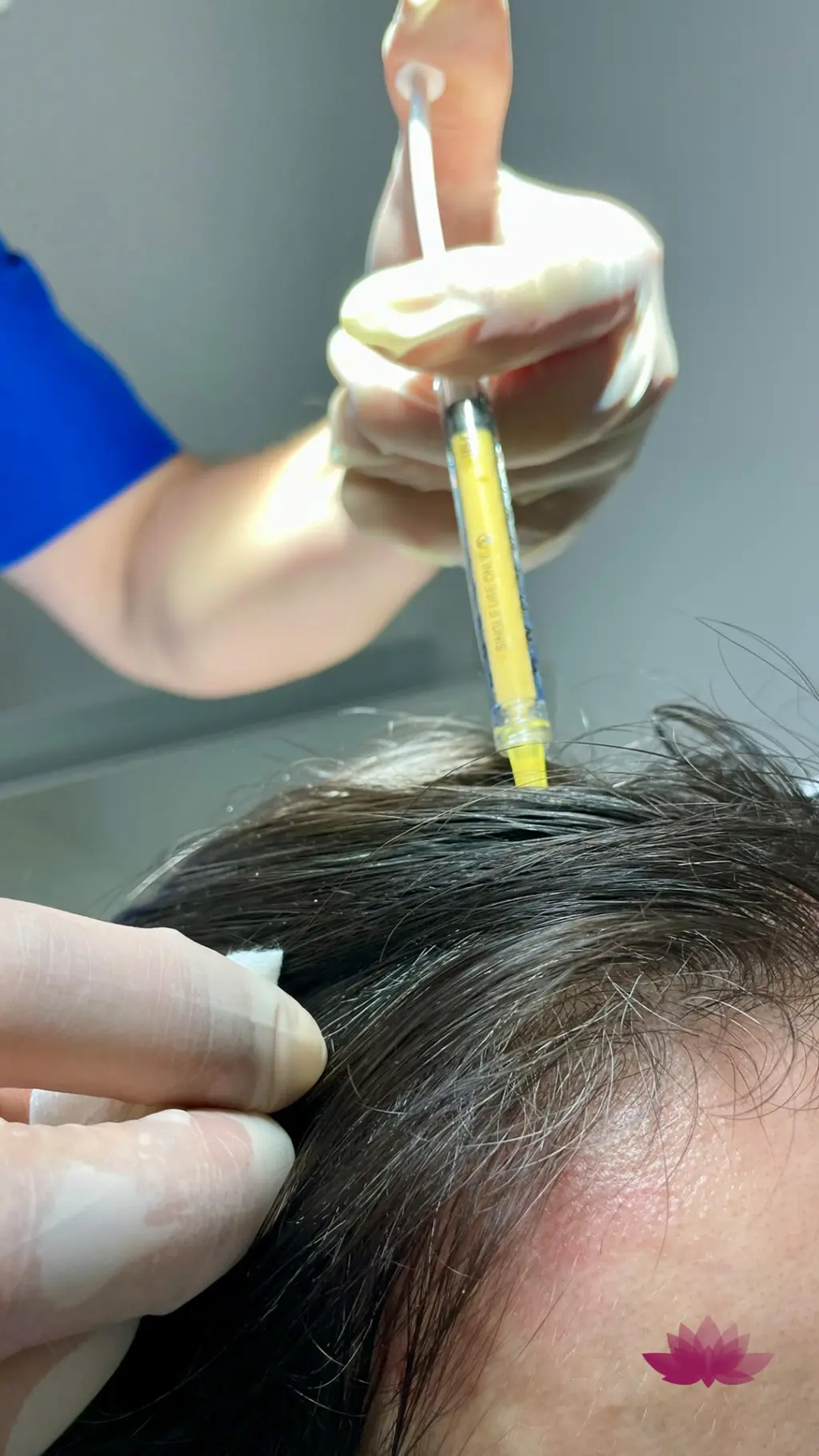 Mezoterapia skóry głowy