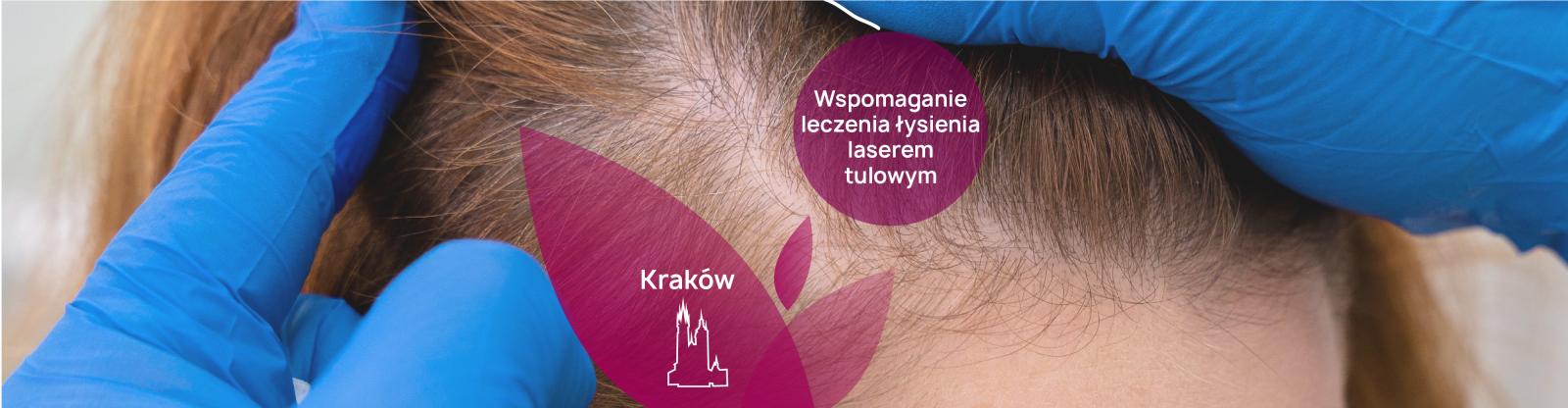 Gdzie wykonać laser tulowy na skórę głowy w Krakowie? - PerfectLift