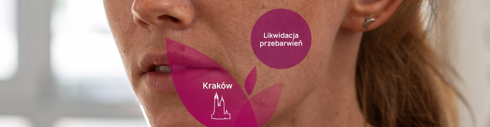 Jakie metody na usuwanie przebarwień Kraków oferuje PerfectLift? - PerfectLift