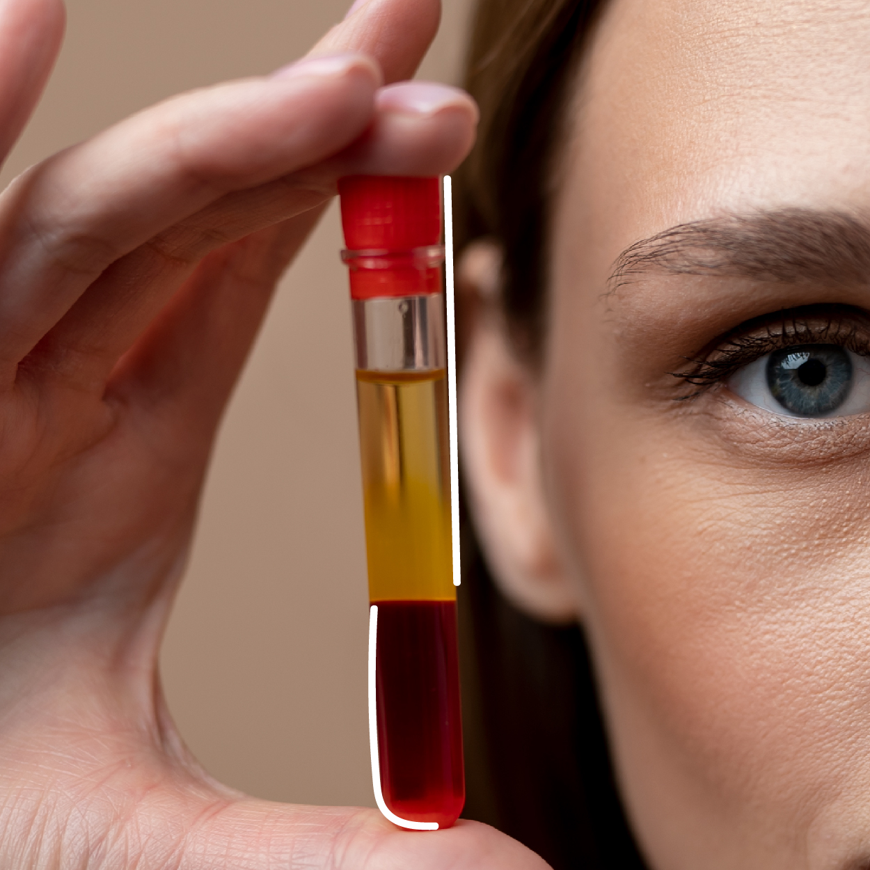 Fibryna bogatopłytkowa - zdjęcie