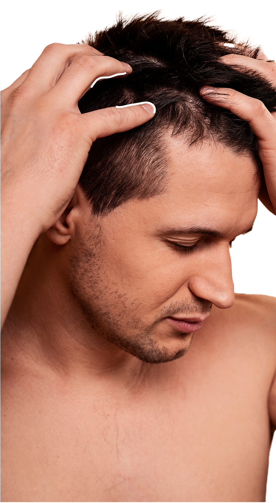 Pacjentka po zabiegu medycyny estetycznej - laser tulowy na skórę głowy w Krakowie