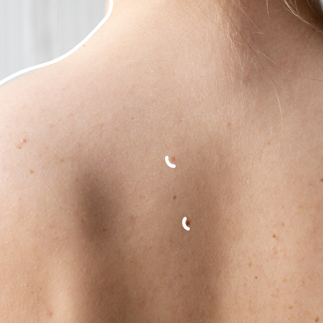 Usuwanie zmian skórnych - zdjęcie